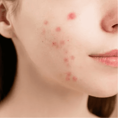 Acne Face/Body Therapy at Esthetics By Cindy in Naples, FL