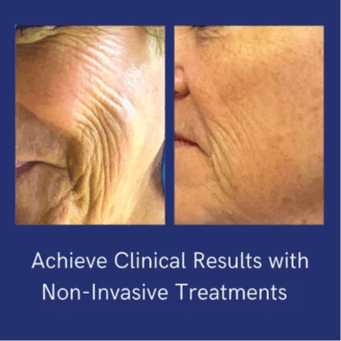 Tone, Lift & Regenerate Therapy at Esthetics By Cindy in Naples, FL
