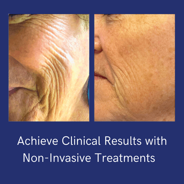 Tone , Lift & Regenerate  Therapy at Esthetics By Cindy in Naples, FL